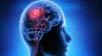 Tumores cerebrales: ¿Son todos peligrosos? elpopular.pe