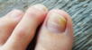 hongos de los pies, ingrediente casero, pies, pies de atleta, mejor ingrediente casero, hongos en las uñas de los pies, hongos de las uñas