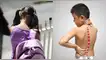 Los pacientes con escoliosis deben tener un seguimiento y tratamiento fisioterapeútico. Escoliosis en niños