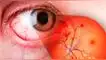 Retinopatia Diabética es un peligro para diebéticos