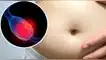 Cáncer de ovario, cáncer, salud, mujer, prevención