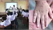 Brote de SARAMPIÓN obliga a suspender clases presenciales en esta ciudad del Perú.