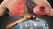 Cáncer de pulmón: ¿Cuáles son los síntomas y cómo se diagnostica?