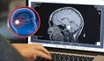 El implante cerebral que apaga la depresión más grave en segundos: conoce la cirugía que está cambiando vidas