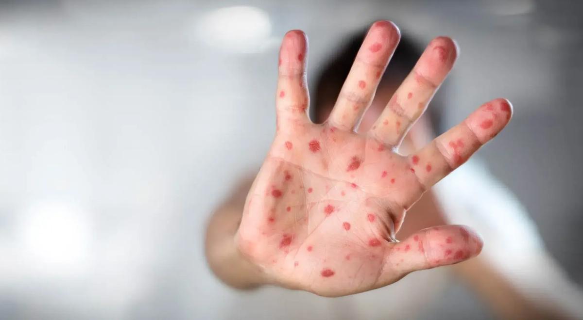 Os casos de sarampo quadruplicaram em apenas 72 horas, apesar da vigilância sanitária na região