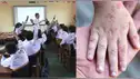 Colegios SUSPENDEN CLASES por brote de SARAMPIÓN en esta ciudad peruana: estudiantes vuelven a virtualidad