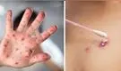 Viruela del mono: 3 cosas que debo hacer para evitar el contagio