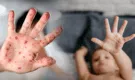 Viruela del mono: ¿Cómo proteger a los niños del contagio?
