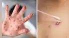 Viruela del mono: 3 cosas que debo hacer para evitar el contagio
