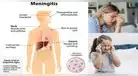 La meningitis puede causar la muerte en menos de 24 horas