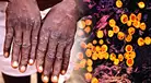 Virus mpox, la enfermedad con potencial pandémico que preocupa a nivel mundial