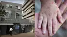 ¿Se suspenderán las clases? Perú registra más de 300 contagios de virus Coxsackie en colegios: esto dice Minedu