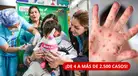 ¡SARAMPIÓN SE DISPARA EN PERÚ! Casos pasan de 4 a más de 2.500 en un año | ESTAS REGIONES ESTÁN EN ALERTA