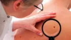 Liga Contra el Cáncer realiza campaña de despistajes contra el cáncer de piel