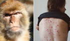 Viruela del mono: Minsa refuerza vigilancia de viajeros extranjeros
