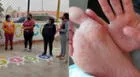 Ica: brote de síndrome mano-pie-boca genera pánico en colegio inicial de Chincha