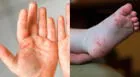 Minsa brinda recomendaciones para tratar el ‘síndrome de manos, pies y boca’ [VIDEO]
