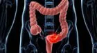 ¿Cómo reconocer las señales del cáncer de colon y qué causa la enfermedad?