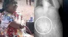 Mujer de 81 años muere tras operación para sacar el feto calcificado de su interior ¿Por qué?