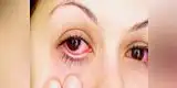 Salud: Casos de conjuntivitis se incrementan por el calor