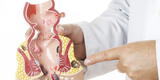 Salud: El virus del papiloma humano produciría el cáncer de ano