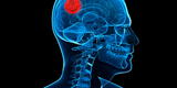 Salud: Síntomas de tumores cerebrales aparecen en forma abrupta y progresiva