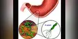 Salud: conoce la bacteria que desarrolla cáncer de estómago