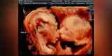 Instagram: ecografía de bebes besándose causa sensación en Internet [FOTOS Y VIDEO]