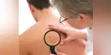 Salud: ¿Cómo distinguir un lunar cancerígeno?