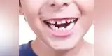 5 hábitos en los niños que generan una mala mordida y dientes chuecos