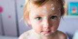 Salud: Cinco datos que no sabías de la varicela