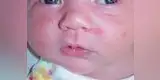Salud: ¿Cómo reconocer y tratar el acné neonatal?