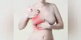 ¿Qué es el cáncer de mama metastásico y cómo reconocer sus síntomas? 
