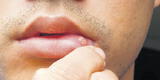 ¿Por qué salen llagas en la boca? Todo lo que debes saber sobre las úlceras bucales
