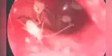 China: Joven fue al hospital por dolor de oído y descubre que tenía crías de cucarachas [VIDEO]