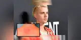 Justin Bieber reveló que sufre la enfermedad de Lyme: ¿Qué es y qué síntomas presenta? [FOTOS]
