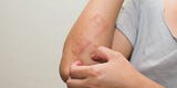 Salud: Leucemia en adultos