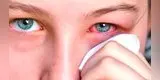 Salud: Lo que debes saber sobre la conjuntivitis alérgica en primavera