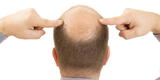 Alopecia: Pérdida anormal del cabello