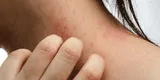 Salud: ¿Cómo podemos evitar la dermatitis?