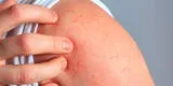 Salud: La dermatitis atópica en esta época