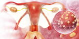 Día Mundial del Cáncer de Ovario: 1 de cada 15 mujeres de 20 años tienen una lesión por VPH