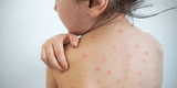 Enfermedades eruptivas en niños: ¿Cómo diferenciarlas y prevenirlas?