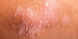 La psoriasis: enfermedad de la piel