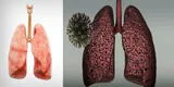 COVID-19: conoce qué le pasa a tus pulmones durante y después de estar infectado