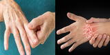 Artritis Reumatoide: 7 señales para detectar la enfermedad a tiempo