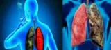 Cáncer de pulmón: ¿cómo reconocer los primeros síntomas?