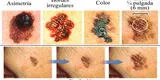 ¿Cómo se puede detectar el cáncer de piel?