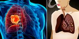 Cáncer de pulmón: ¿Cómo reconocer los síntomas iniciales y qué tratamiento debo llevar?