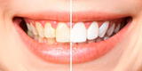 5 trucos caseros para blanquear los dientes con remedios naturales